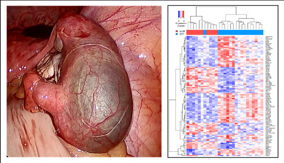 An ectopic pregnancy can result in tubal rupture which accounts for the mortality associated with this condition. Gene expression profiling of the endometrium from women with ectopic compared with that of women with miscarriage, revealed a 5-gene classifier that reliably delineated pregnancy location.