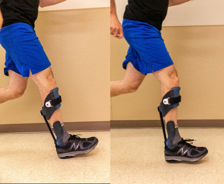 Training individuals with musculoskeletal injuries who use ankle-foot orthoses to shift from a heel strike pattern to a midfoot or forefoot strike pattern takes better advantage of the energy-storing-and-returning properties of the device.