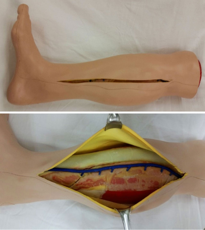 Figure 1: The simulated lower leg used a part of the physical model-based curriculum to teach fasciotomy demonstrating a correct skin incision (upper image), but an incomplete fasciotomy (lower image)