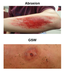 Many medical combat training scenarios incorporate theatrical makeup (moulage) to simulate wounds. The Val G. Hemming Simulation Center has developed a variety of temporary wound tattoos specifically for medical combat simulations. Custom medical illustrations were created from real-world injury references and printed on commercially available tattoo paper. Our detailed renderings ensures precise and detailed wounds that can stand alone or act as a base for further application of traditional moulage.