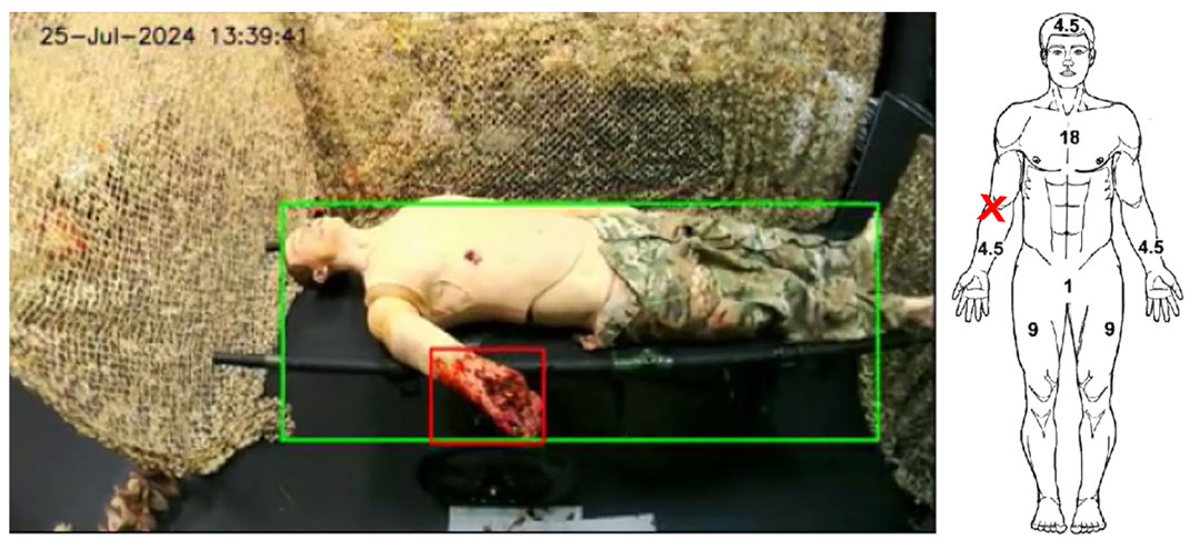 Figure 4. Example Video footage with TATRC partner Arete’s machine vision model identifying a Right Arm Amputation and automatically placing an indicator on a DD Form 1380 (tactical combat casualty care card).